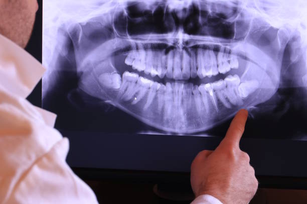 Best Emergency Treatment for Dental Infections or Abscesses in Port St Lucie, FL