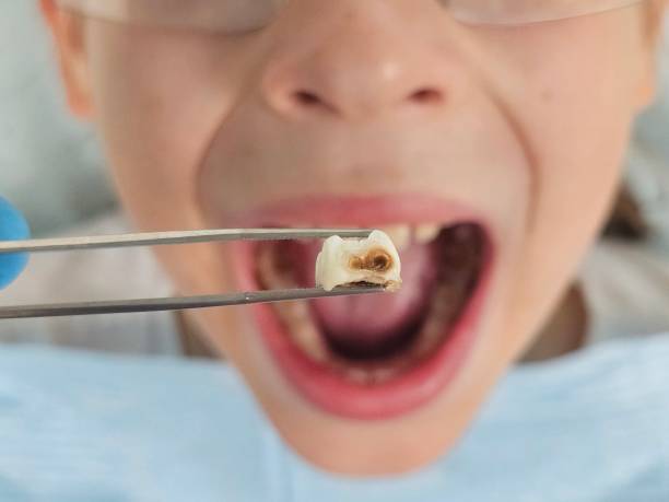 Best Emergency Dental Care for Broken or Chipped Teeth in Port St Lucie, FL